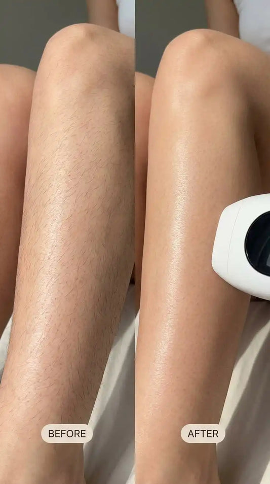 IPL Laser Hair Removal Device – Permanent Hair Reduction for Face & Body