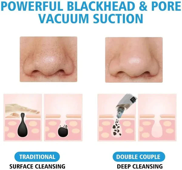 Blackhead Remover | 5-in-1 Deep Pore Cleansing Tool